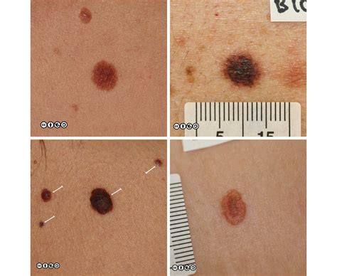 pictures of first stage melanoma